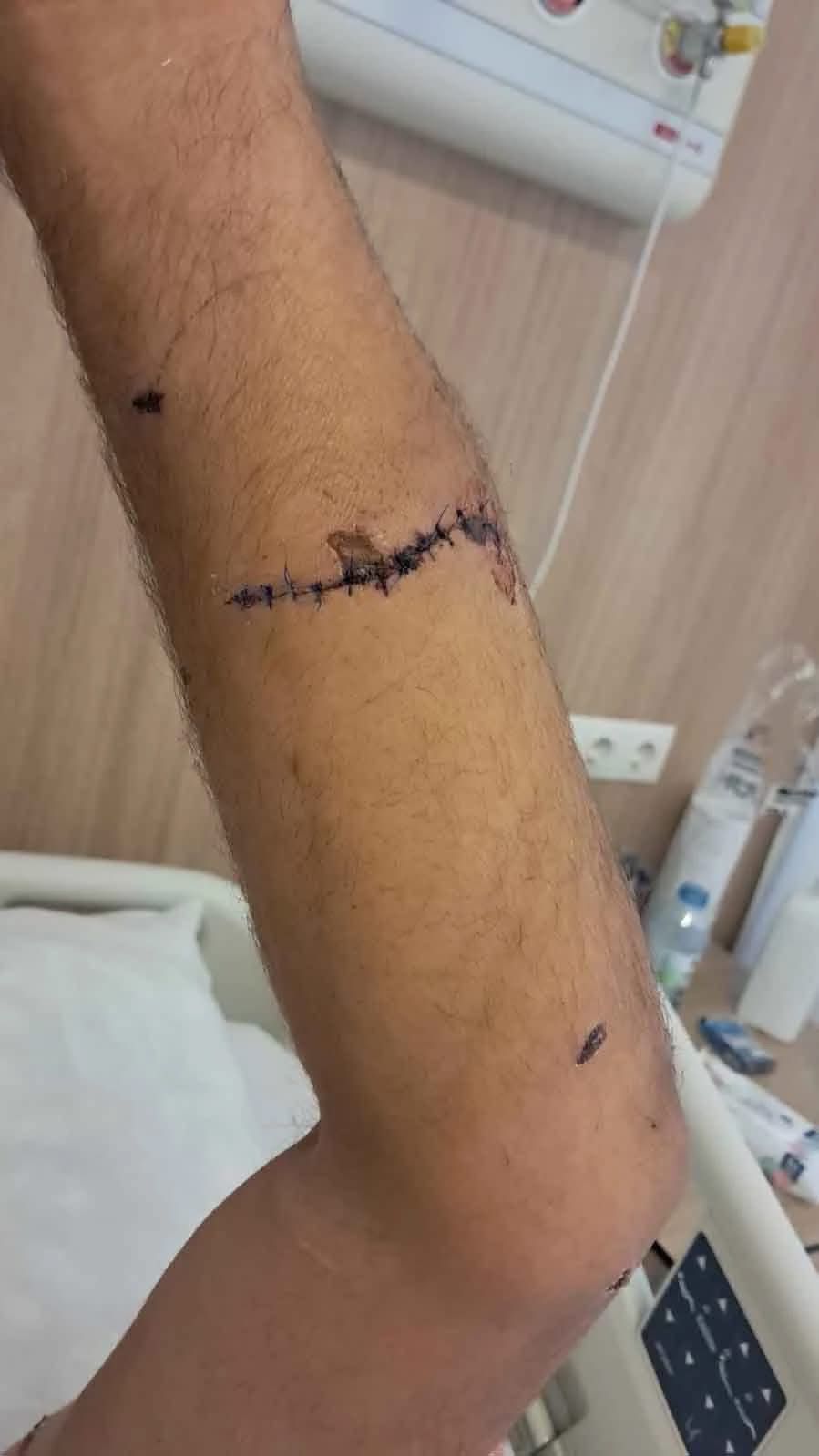 Ayının Saldırısına Uğrayan Çiftçi Dehşet Anlarını Anlattı Parmağımı Kopardı (2)