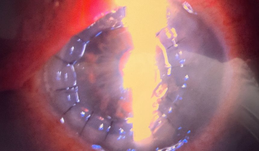 74 yaşındaki kadının karanlık dünyası kornea nakliyle aydınlandı